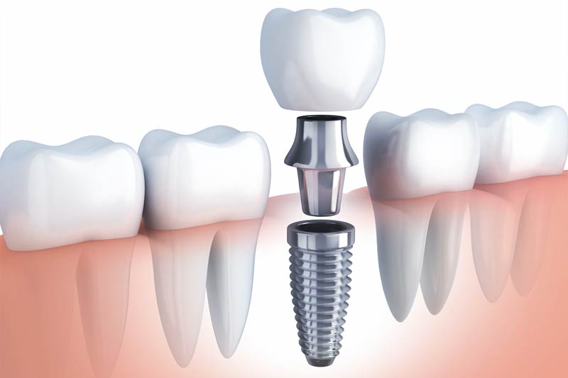 Implants Dentist in Colorado Springs