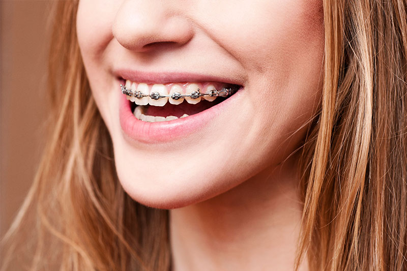 Orthodontics in Colorado Springs