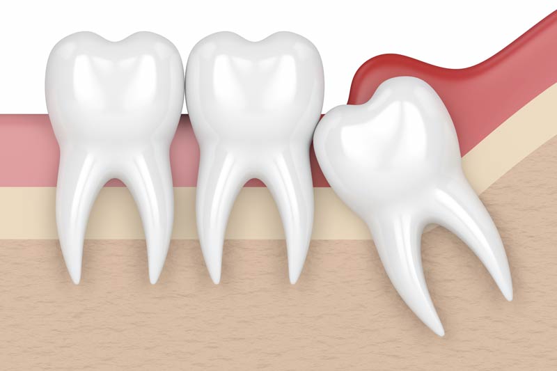 Wisdom Tooth Removal in Colorado Springs